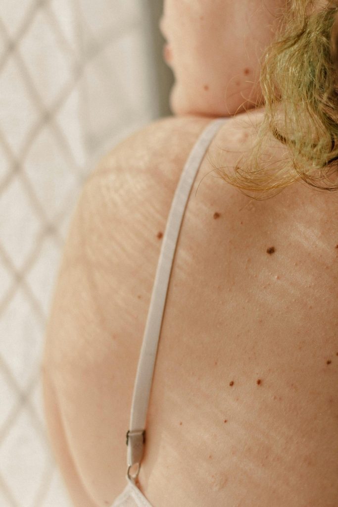 Artistic close-up of a woman's freckled back and shoulder with natural lighting.